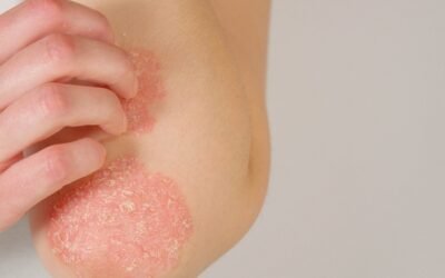 Home Remedies for Eczema Flare-Ups in Adults