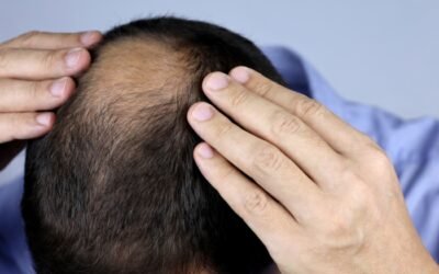 Hair Loss and Baldness Treatment: Strategies for Resilient Hair