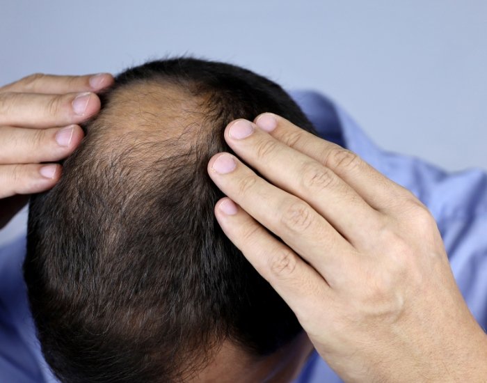 androgenetic alopecia treatment