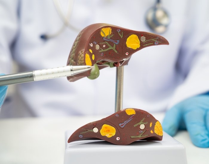 Symptoms of Fatty Liver Disease