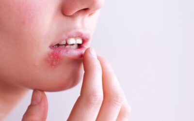 What Does Herpes Look Like in the Mouth? Oral Herpes Guide