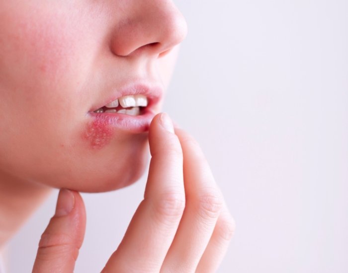 oral herpes symptoms